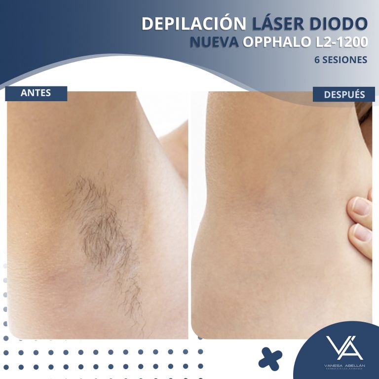 Depilación Laser Diodo